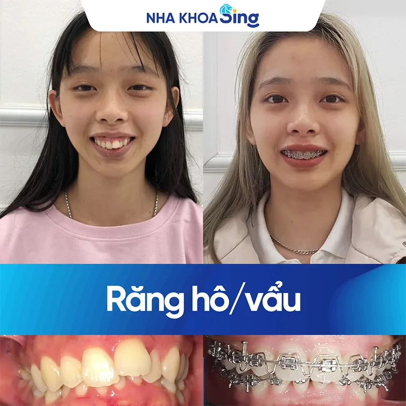 nieng-rang-ho-nang