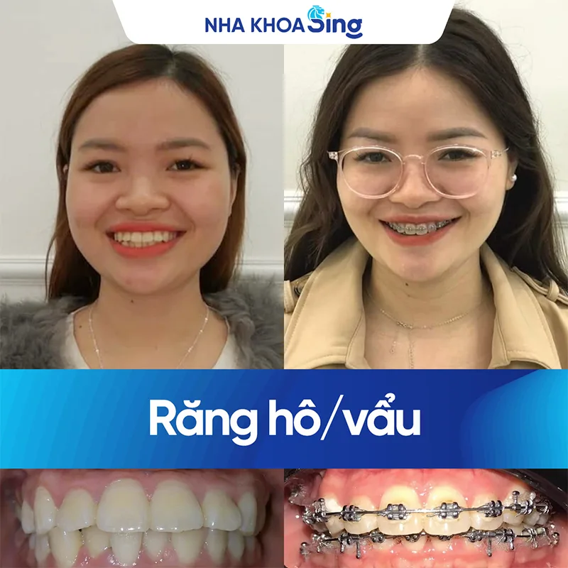 nieng-rang-ho-nhe