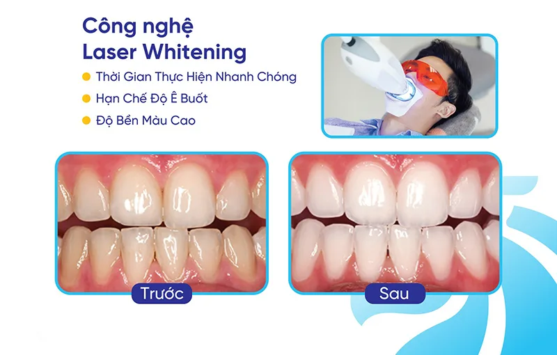 tay-trang-rang-laser-whitening-nha-khoa-sing