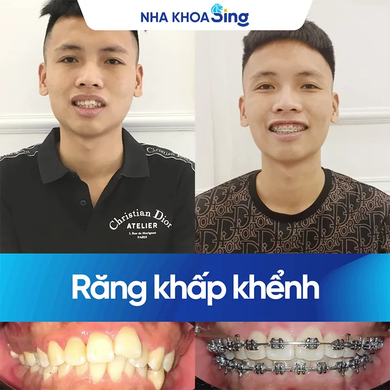 truoc-va-sau-khi-nieng-rang-khenh-1