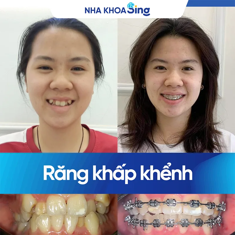 truoc-va-sau-khi-nieng-rang-khenh
