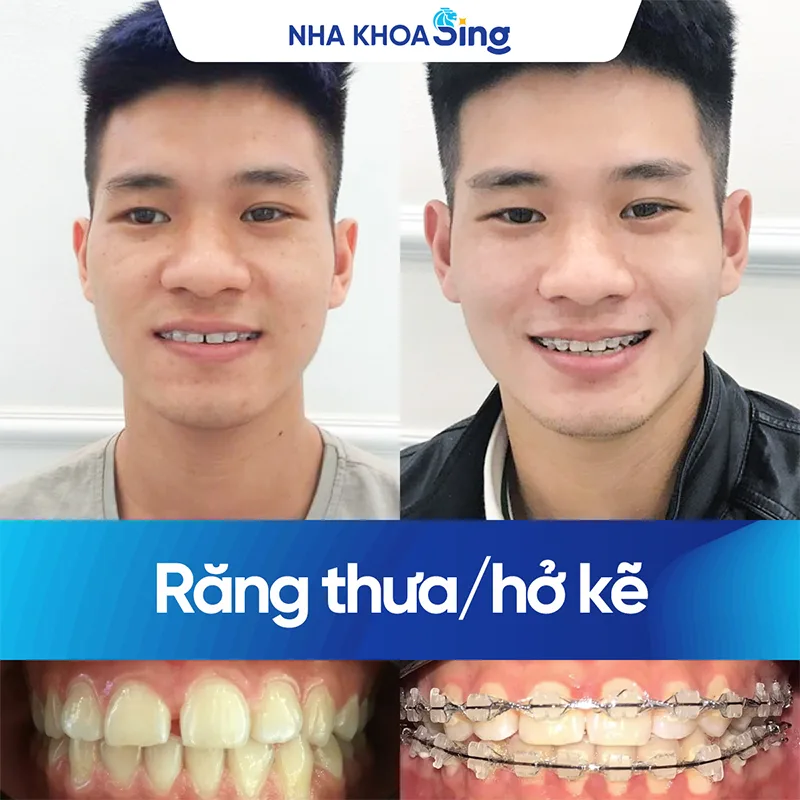 khach-hang-nieng-rang-mac-cai-su-nha-khoa-sing