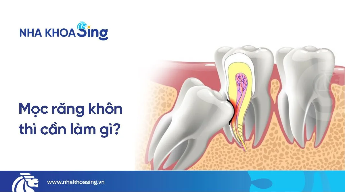 Mọc răng khôn: Triệu chứng và cách giảm đau & xử lý triệt để