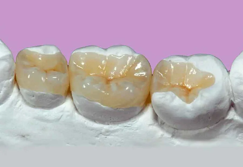 tram-rang-inlay-onlay-gia-bao-nhieu