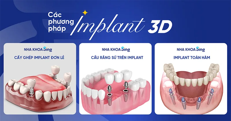trong-rang-implant-1.