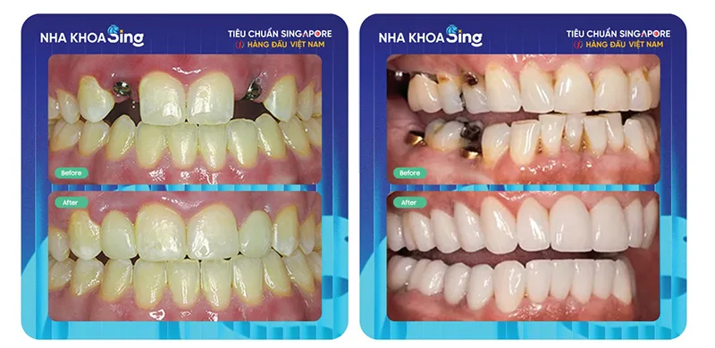 trong-rang-implant-3