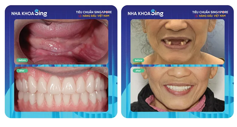 trong-rang-implant-4
