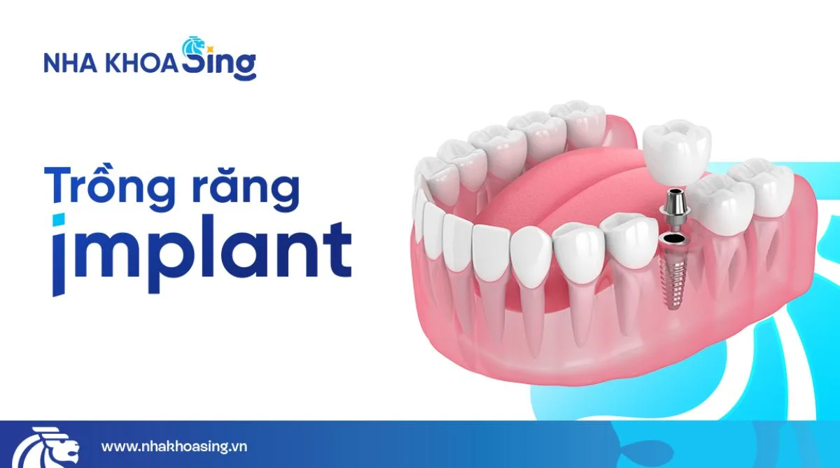 Trồng răng Implant: Tổng quan, quy trình chi tiết và chi phí