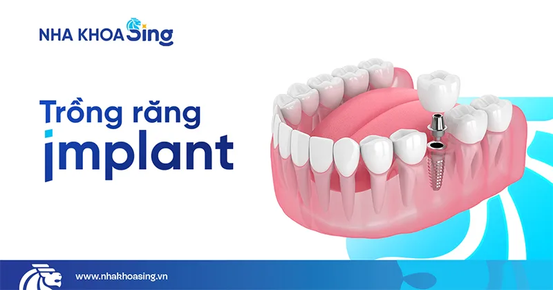 trong-rang-implant.