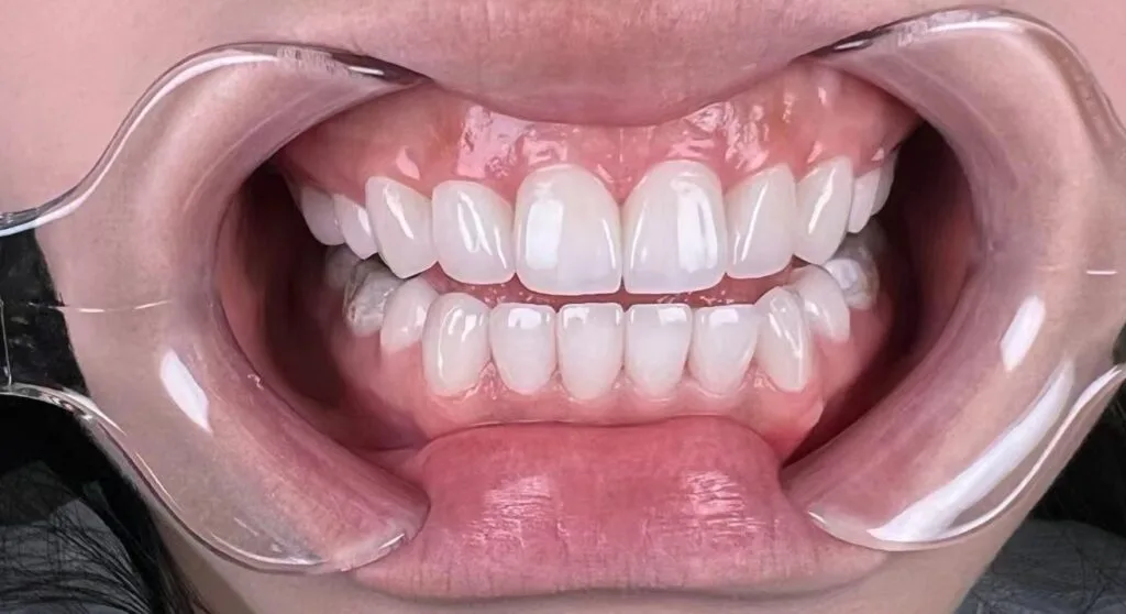 Rang-su-co-bi-mon-khong-1024x558