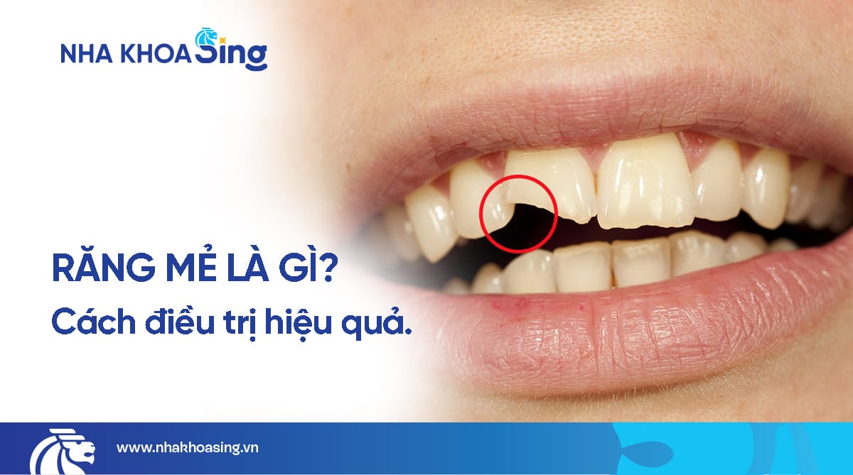 Răng mẻ là gì? Phương pháp phục hình răng bị mẻ hiệu quả