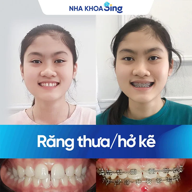 rang-thua-1