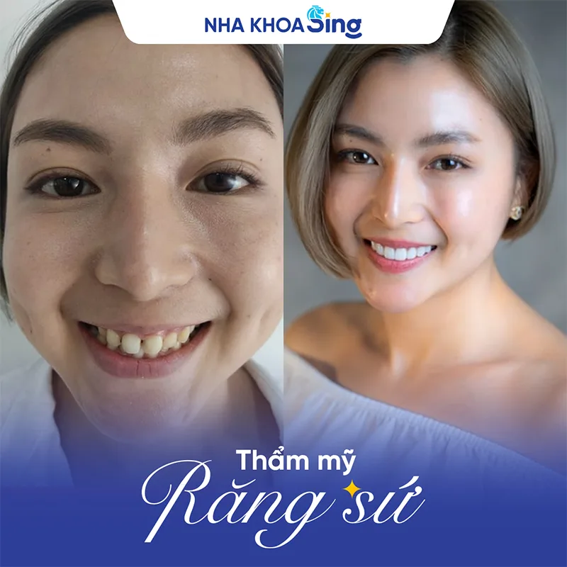 rang-thua-2