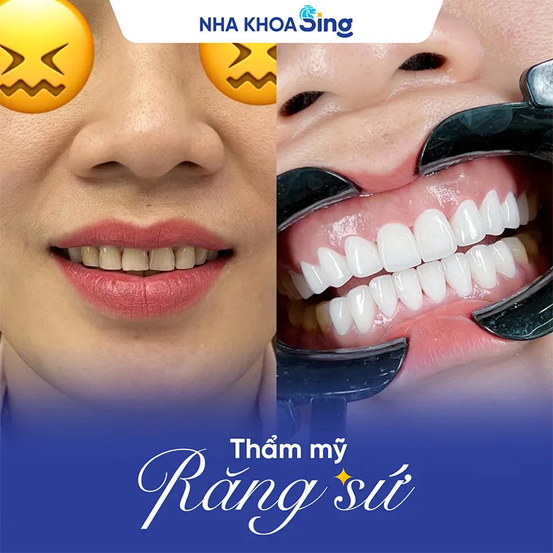 boc-su-cho-rang-ham-3