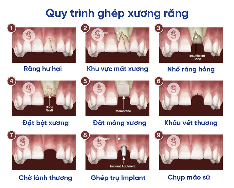 ghep-xuong-rang-2
