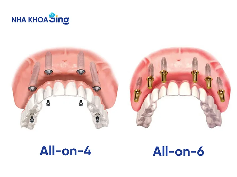 trong-rang-su-co-dinh-3