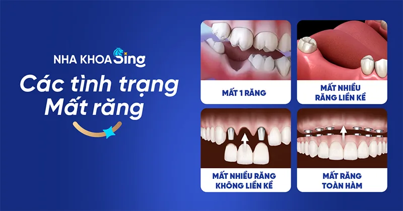 trong-rang-su-co-dinh-4