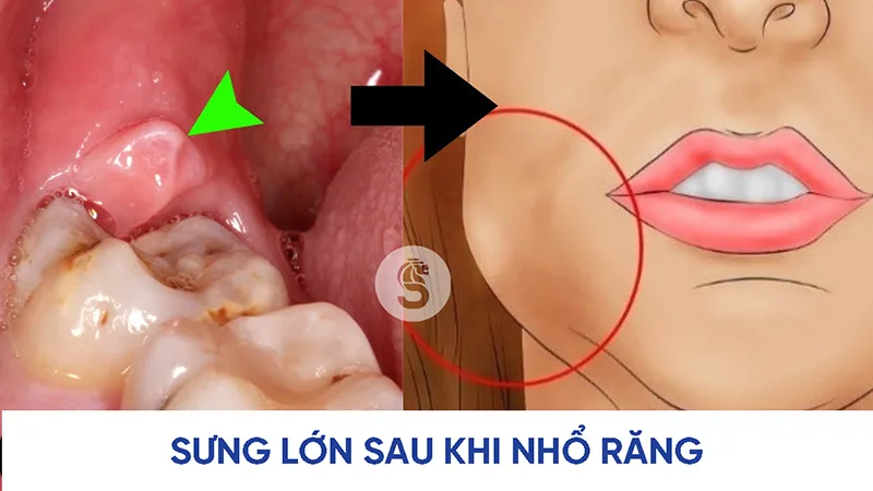 dau-hieu-nhiem-trung-sau-khi-nho-rang-1