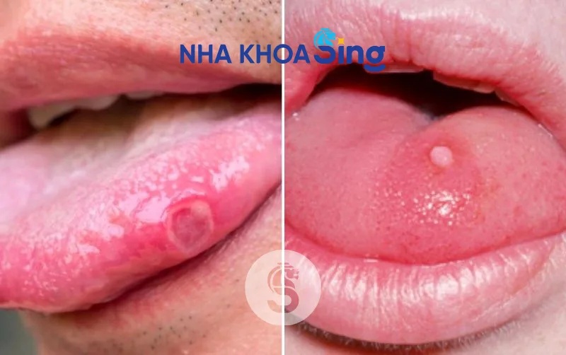 hinh-anh-nhiet-luoi