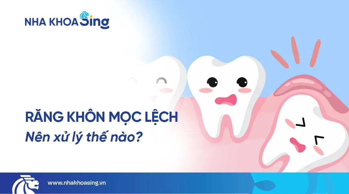 Răng khôn mọc lệch có sao không? Nên xử lý như thế nào?