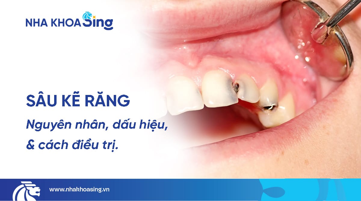 Sâu kẽ răng: Nguyên nhân, triệu chứng và cách điều trị