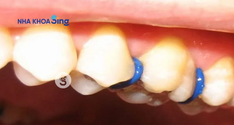 cac-giai-doan-nieng-rang-1