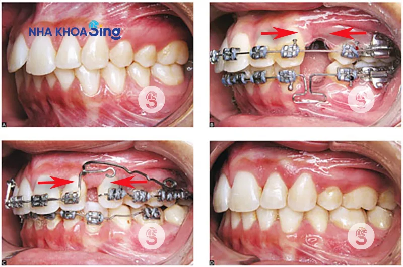 cac-giai-doan-nieng-rang-2