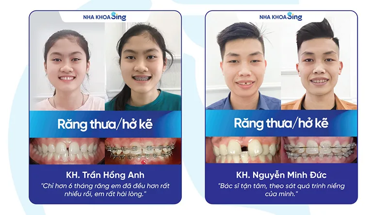 cac-loai-nieng-rang-4