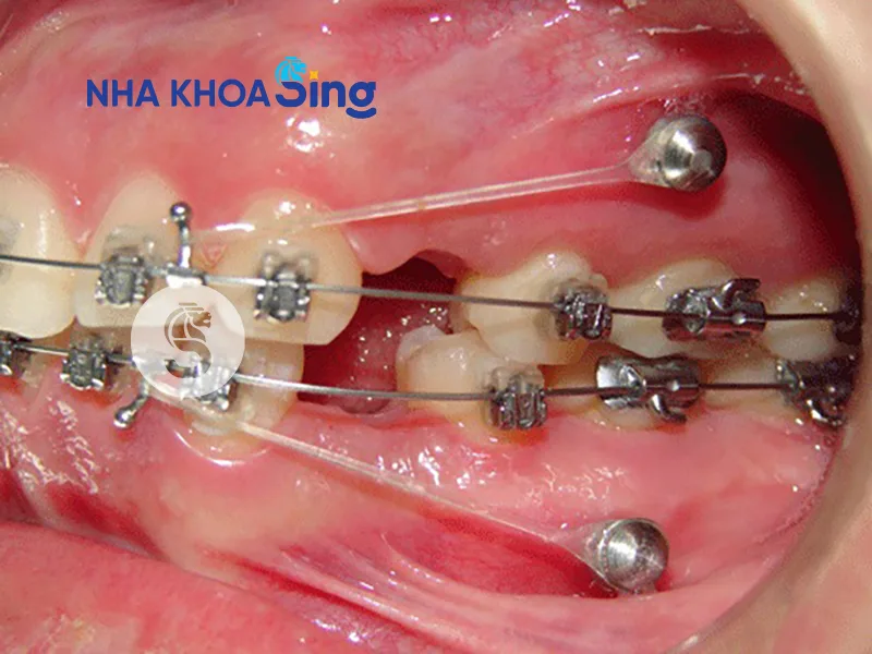 mat-rang-co-nieng-duoc-khong-1