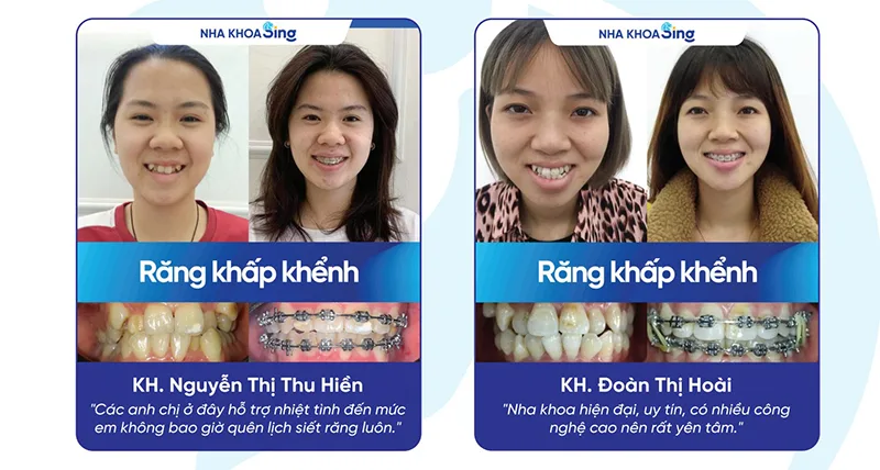 mat-rang-co-nieng-duoc-khong-2