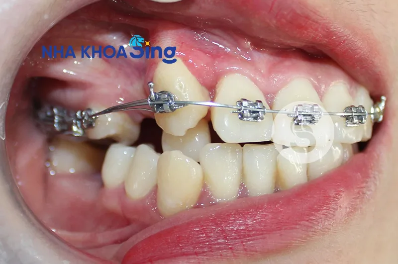 mat-rang-co-nieng-duoc-khong
