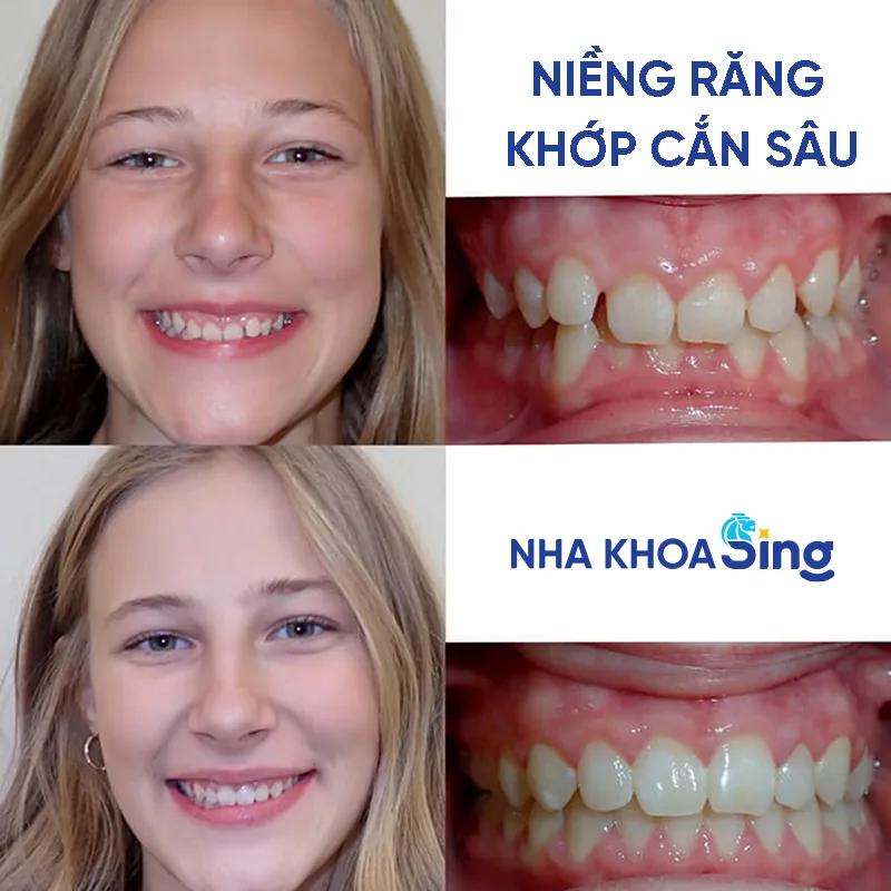 nieng-rang-khop-can-sau-4