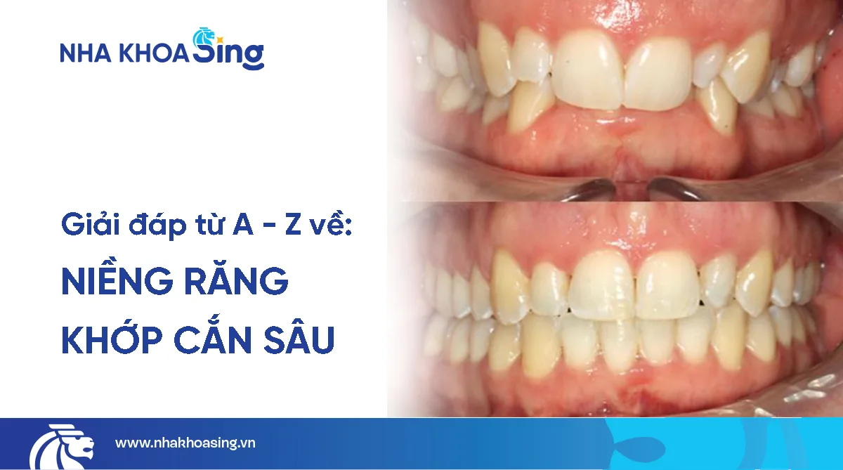 Niềng răng khớp cắn sâu: Quy trình, thời gian & lưu ý cần biết