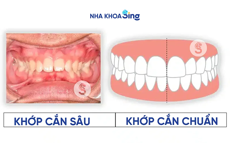nieng-rang-khop-can-sau