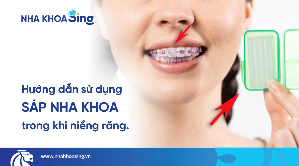 Sáp nha khoa trong niềng răng là gì? Cách dùng và lưu ý