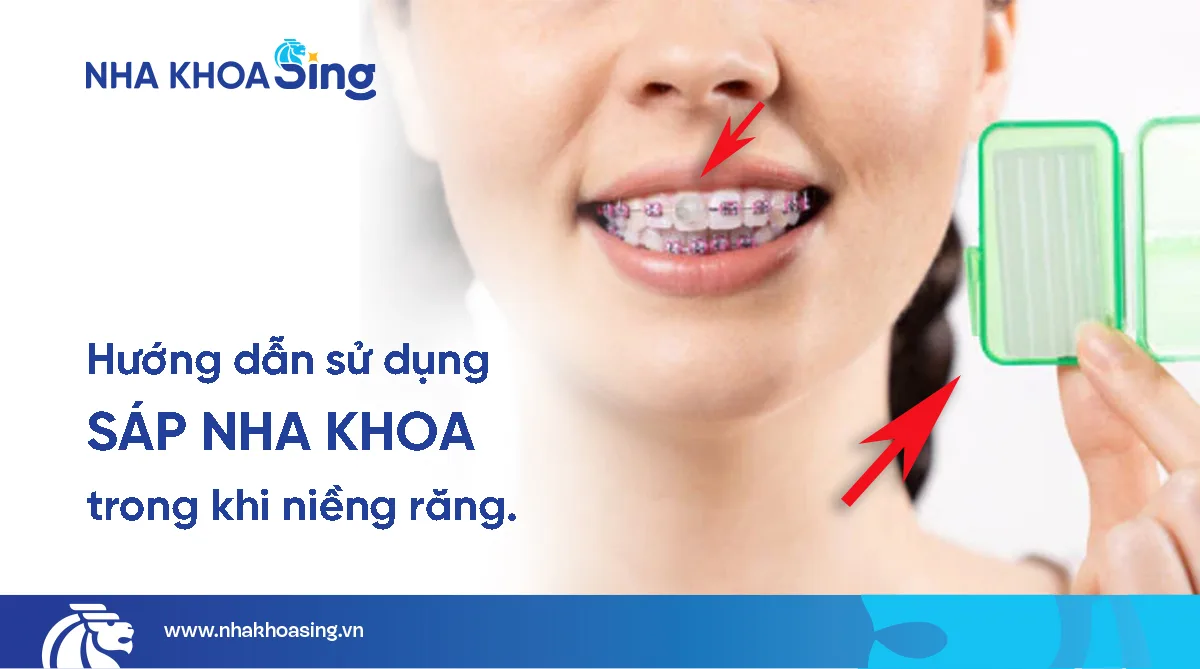 Sáp nha khoa là gì? Cách dùng, lưu ý và giải đáp khi niềng răng