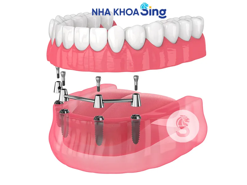trong-rang-implant-all-on-4-1