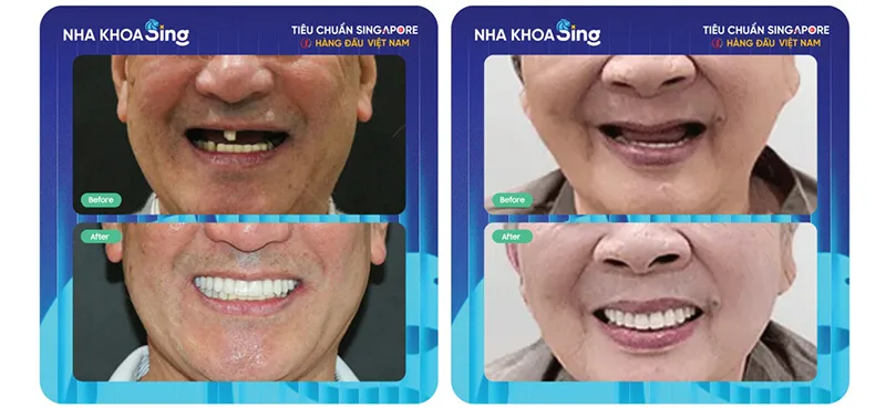 trong-rang-implant-all-on-4-2