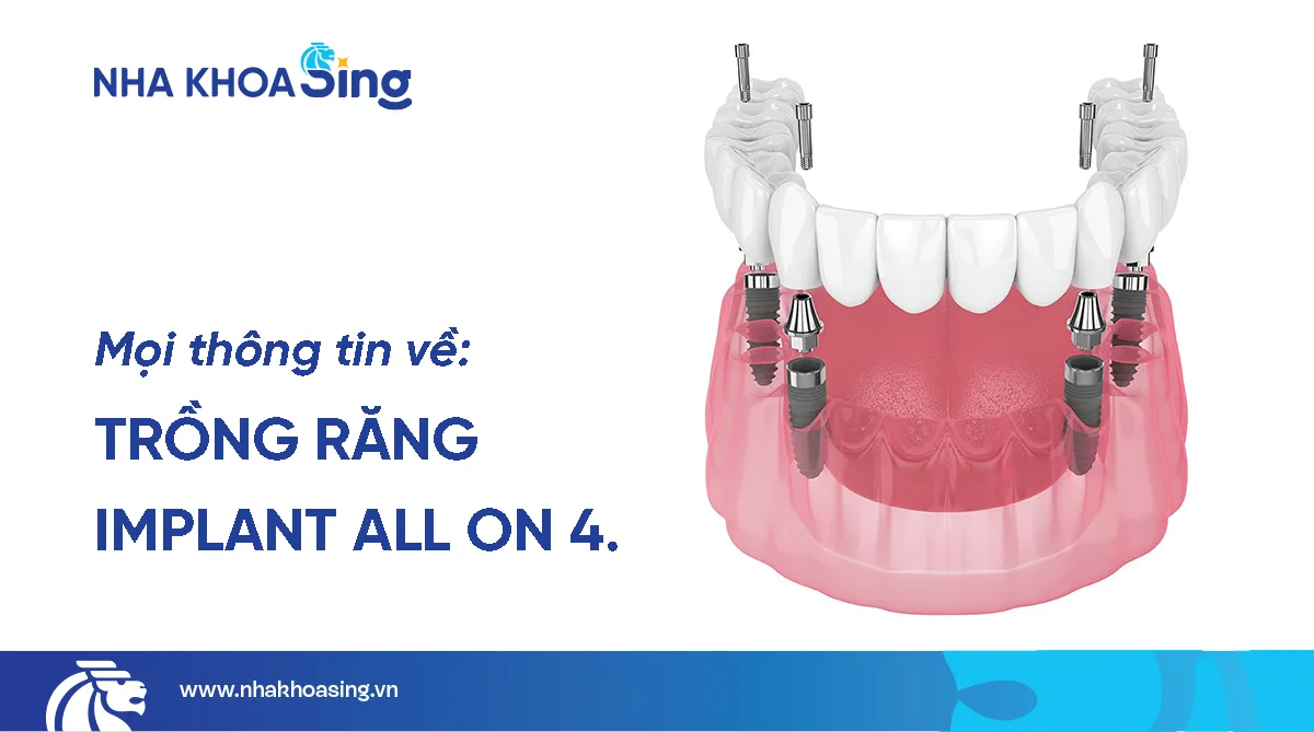 Trồng răng Implant All On 4: Lựa chọn tối ưu cho người mất răng toàn hàm
